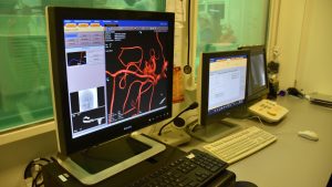 Enfermedades Cardiovasculares: La atención precoz disminuye las complicaciones y baja la mortalidad